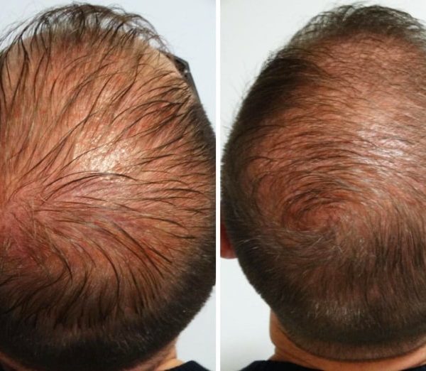 درمان ریزش مو با مزونیدلینگ